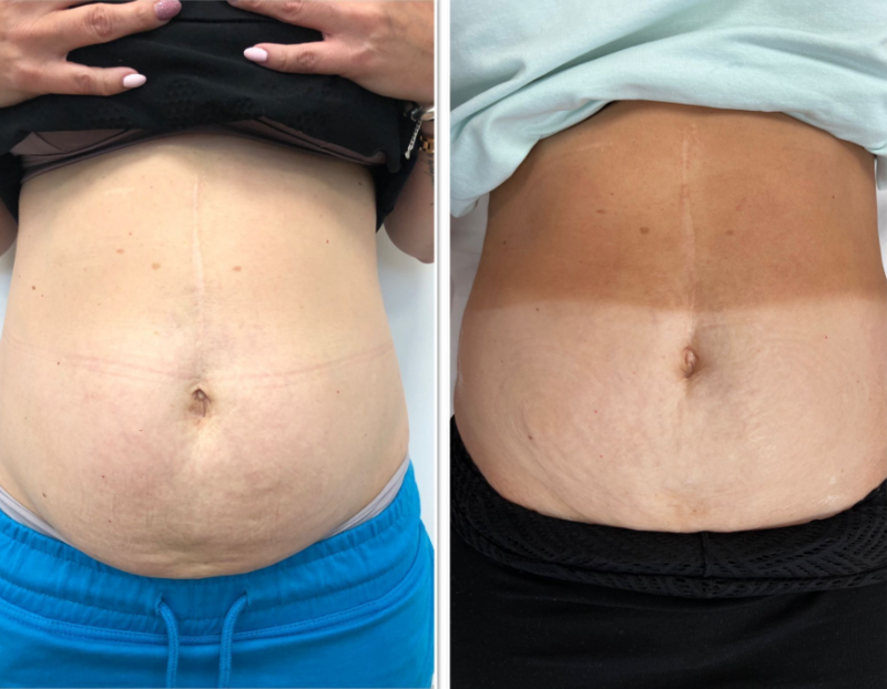 Modelowanie brzucha - efekty przed i po