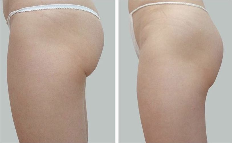 Redukcja cellulitu - widoczne rezultaty