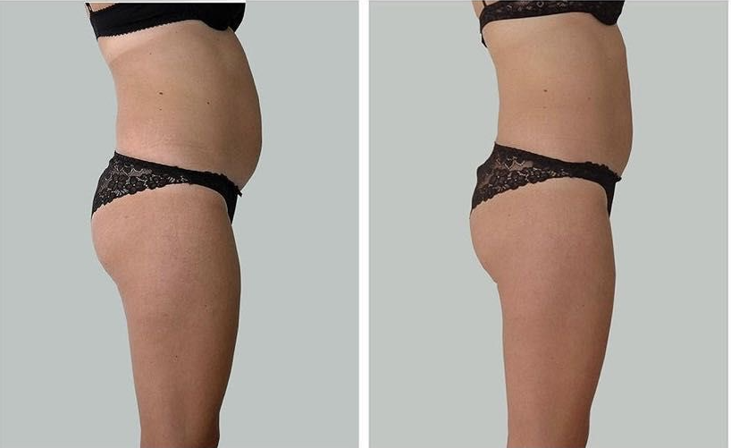 Wysmuklenie ud i pośladków