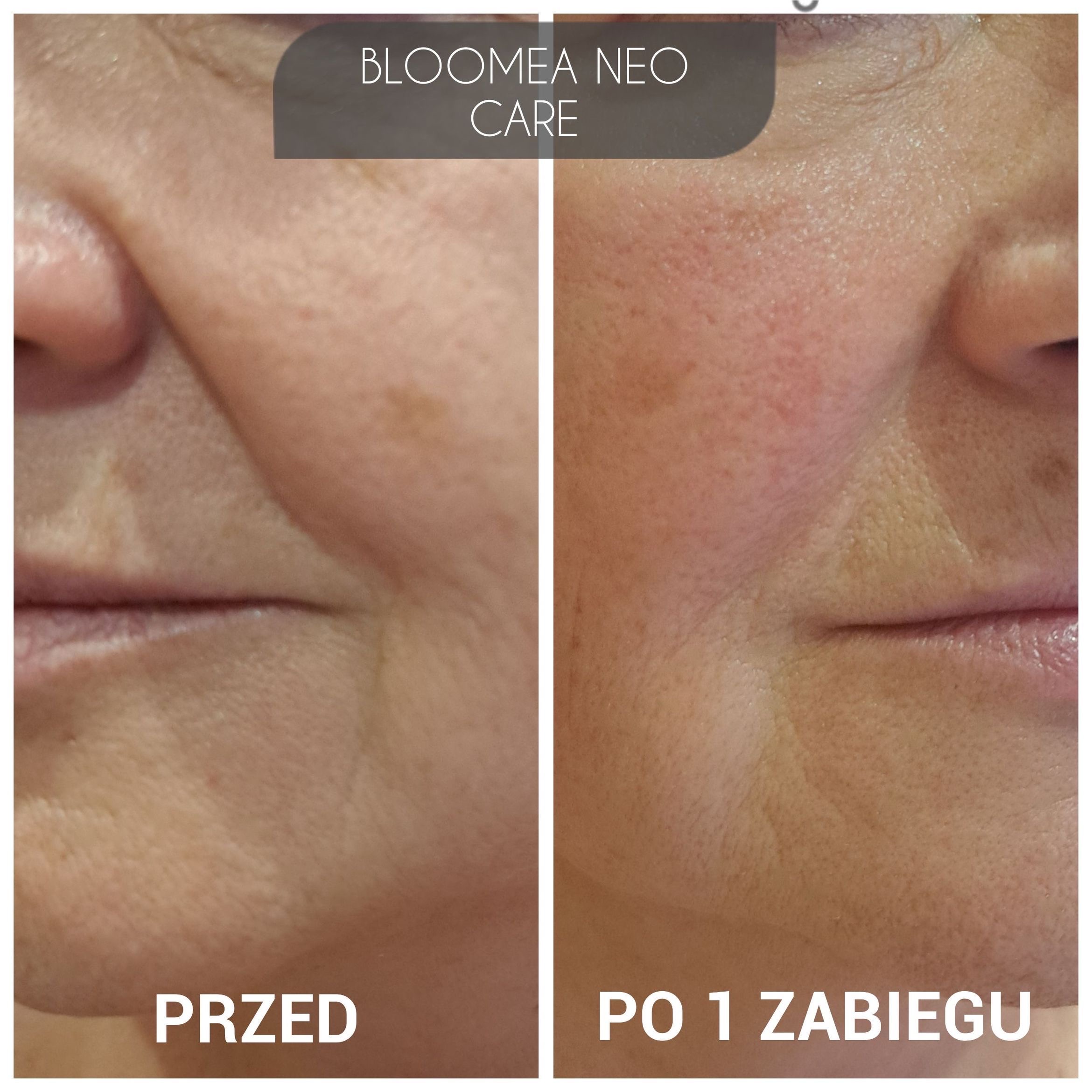 Efekty zabiegów BLOOMEA NEOCARE