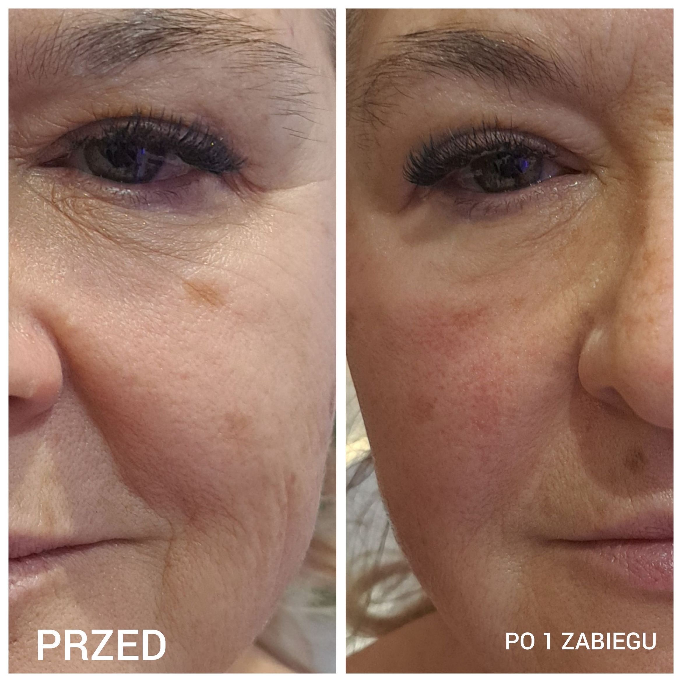 Profesjonalne zabiegi BLOOMEA NEOCARE